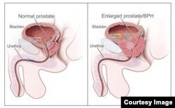 Illustration showing the size of normal and enlarged prostate. (Courtesy of the National Cancer Institute)