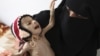 سازمان ملل:در یمن بیش از ده میلیون نفر گرسنه هستند