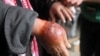 Likitan fata a Najeriya Farfesa Shehu Yusuf ya yi bayani da ba da shawarwari kan Moles/Skin Tags da kuma lokacin da ya kamata a nemi taimako