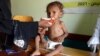 Haweeney Yemeniyad ah oo ilmo nafaqo-xumo hayso ku quudineysa xarun caafimaad oo ku taal gobolka uu dagaalku ragaadiyay ee Hodeidah
