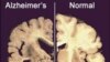 Antibody Therapy Clears Destructive Alzheimer’s Brain Plaques 