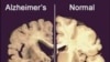 Researchers Identify Potential Cause of Alzheimer's Damage