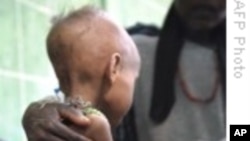 Many Severely Malnourished Children in Ethiopia at Risk Of Death