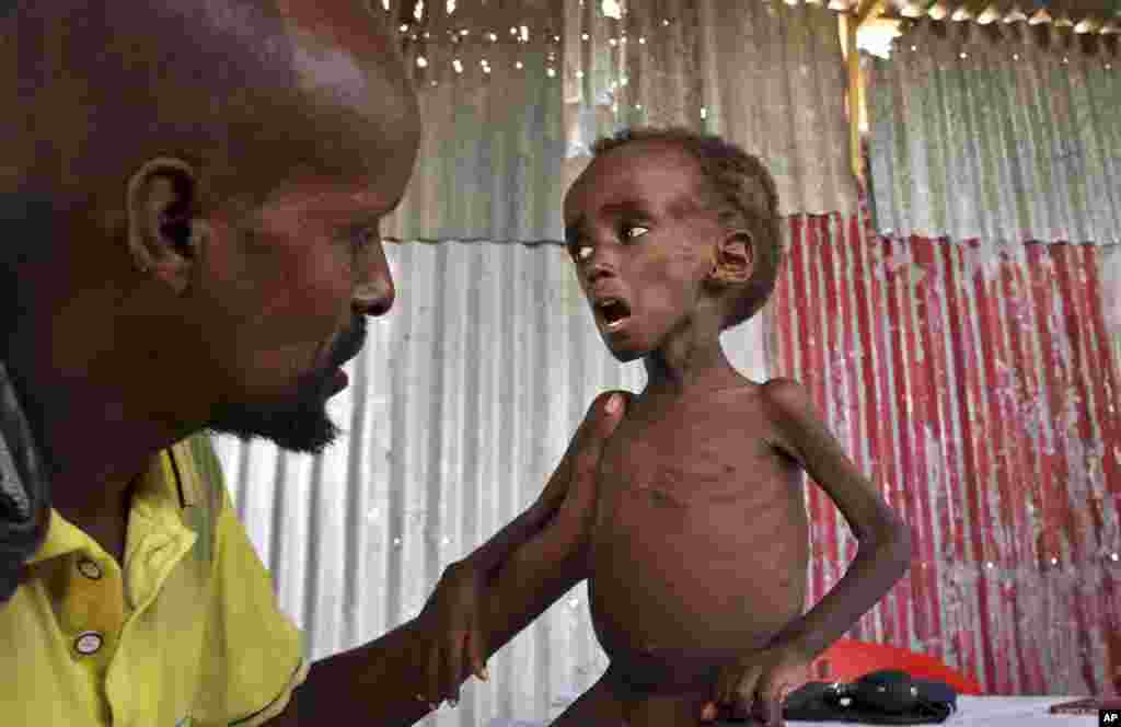 Ali Madey holds his malnourished child, Mohamed Ali, 5, at their camp for the displaced on the outskirts of Mogadishu, Somalia.