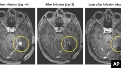 This combination of MRI scan images provided by the New England Journal of Medicine in March 2024 shows the progress of a glioblastoma patient who received CAR-T therapy which uses modified versions of T cells from a patient's own immune system. (NEJM via AP)