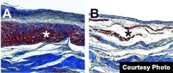 Microscopic images of pig hearts damaged by heart attack show the growth of new heart muscle tissue (shown in red, Figure A) after treatment with an injectable hydrogel compared to a heart left untreated (Figure B, right). Image Credit: Karen Christman, UC San Diego Jacobs School of Engineering.