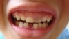 More Americans Turn to ER for Dental Care