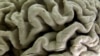 Large Study Details Years of Brain Changes in Alzheimer’s Patients