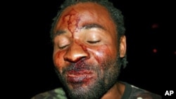 Mário Domingos, organizador de uma a manifestação de 10 de Março contra Suzana Inglês, após ter sido agredido por desconhecidos em Luanda