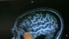 In lab tests, a new contrast agent highlighted the telltale protein deposits that are characteristic of Alzheimer's disease.
